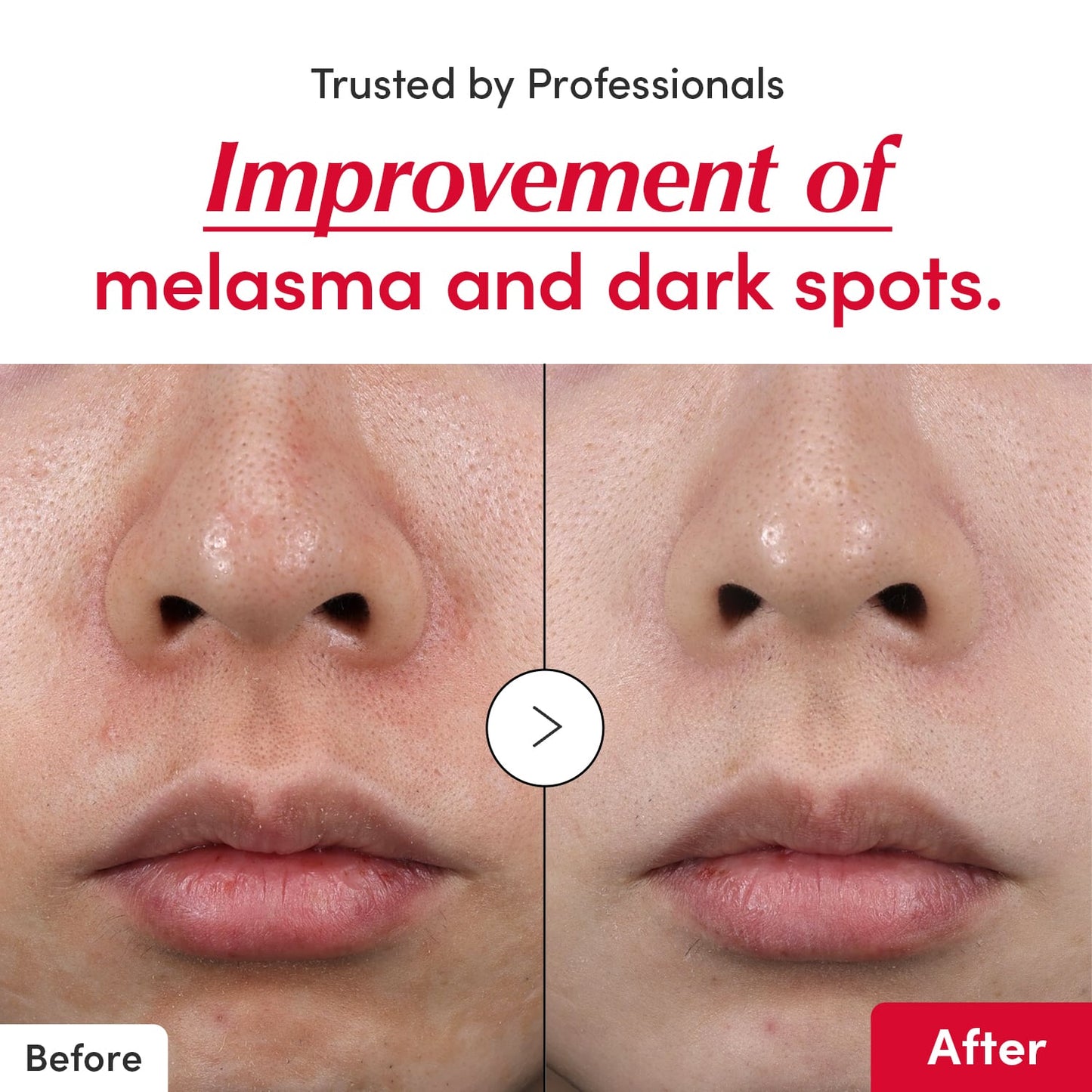 [Amazon] Dark Spot & Acne Mark Vitamin C Serum