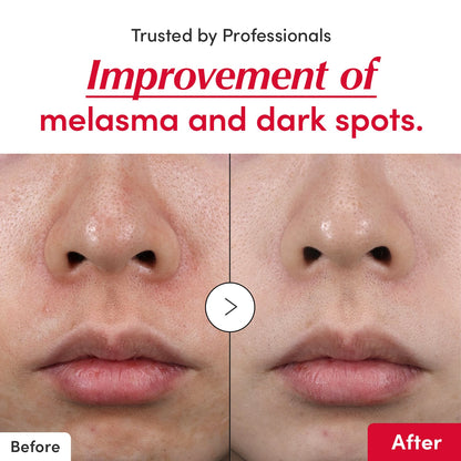 [Amazon] Dark Spot & Acne Mark Vitamin C Serum